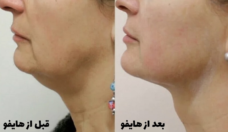 عکس قبل و بعد هایفو